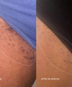 Alternative view of High Roller Ingrown Tonic